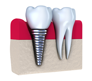 Dental Implants | Dentist in Albany, NY | Rose Dental Associates